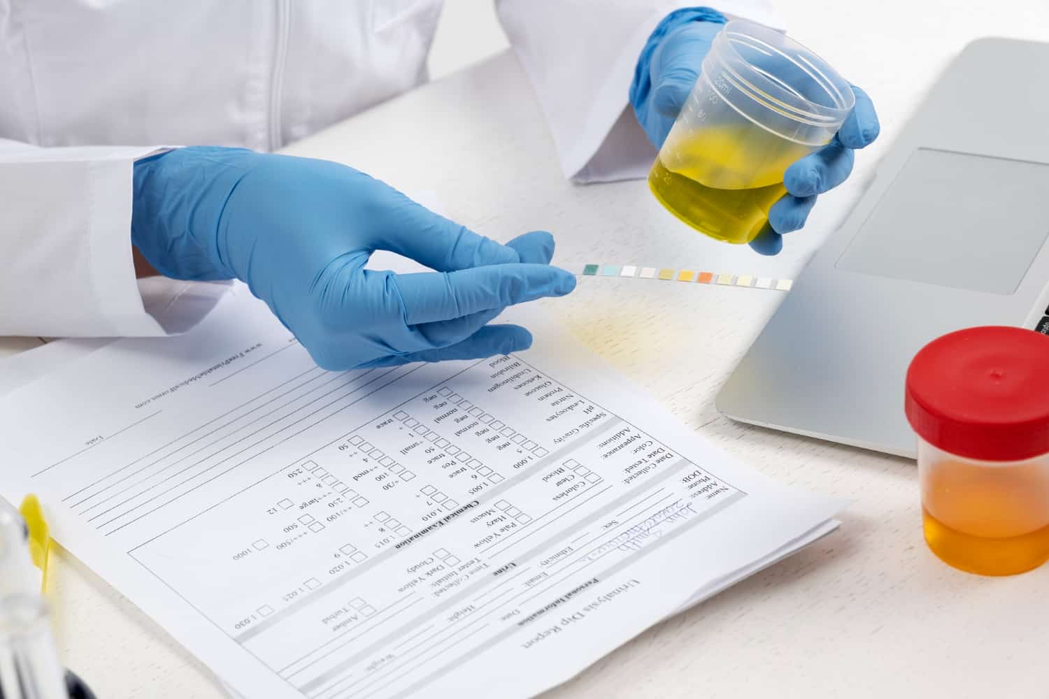 A medical professional in blue gloves holds a urine sample cup over a test strip and lab documents.